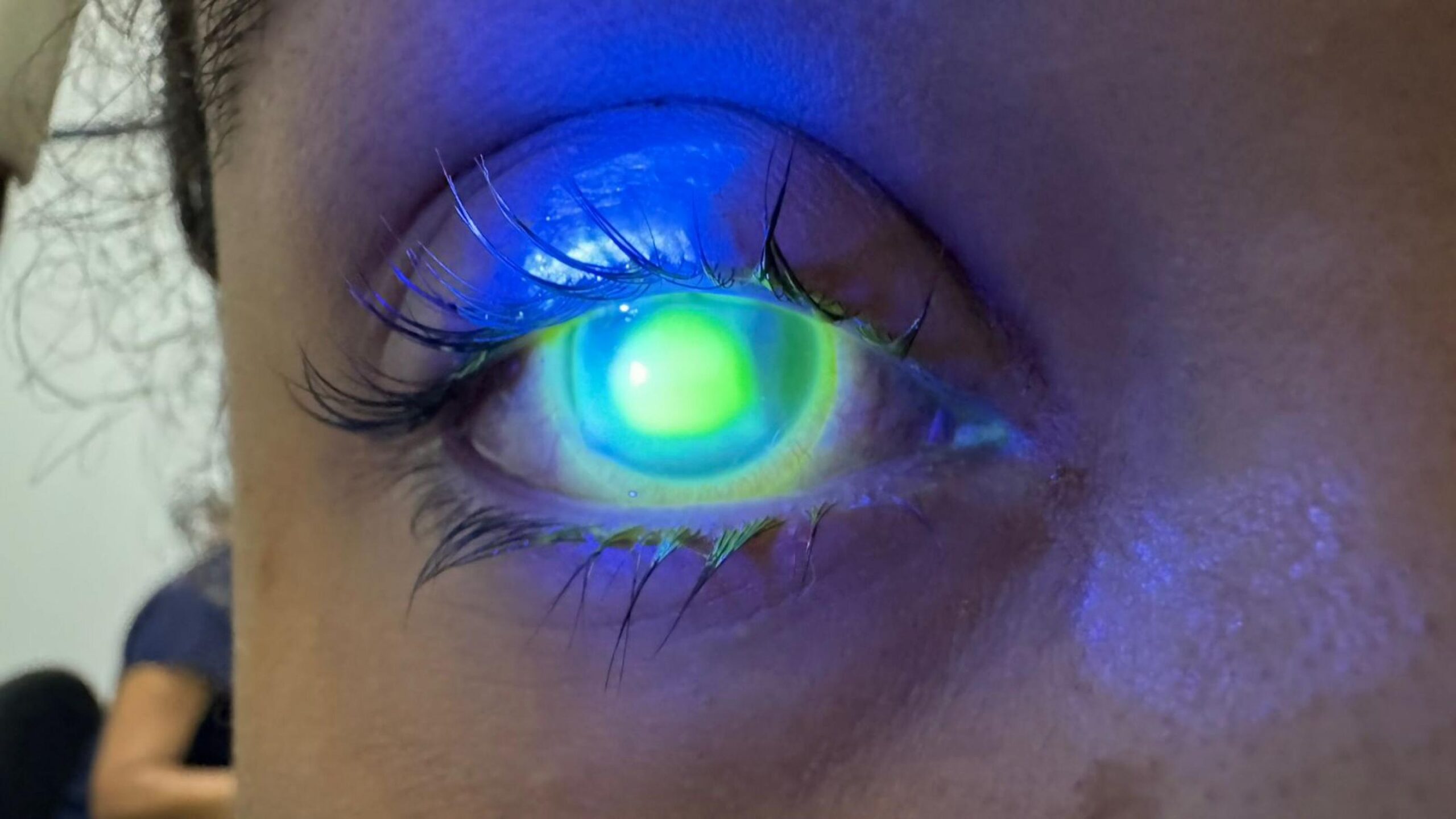 Oftalmologista do HGE alerta sobre o cuidado com os olhos durante o Carnaval